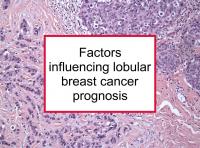Factors influencing lobular breast cancer prognosis