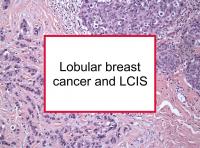 Lobular breast cancer and LCIS