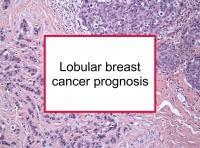 Lobular breast cancer prognosis