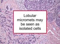 Lobular micromets may be misclassified