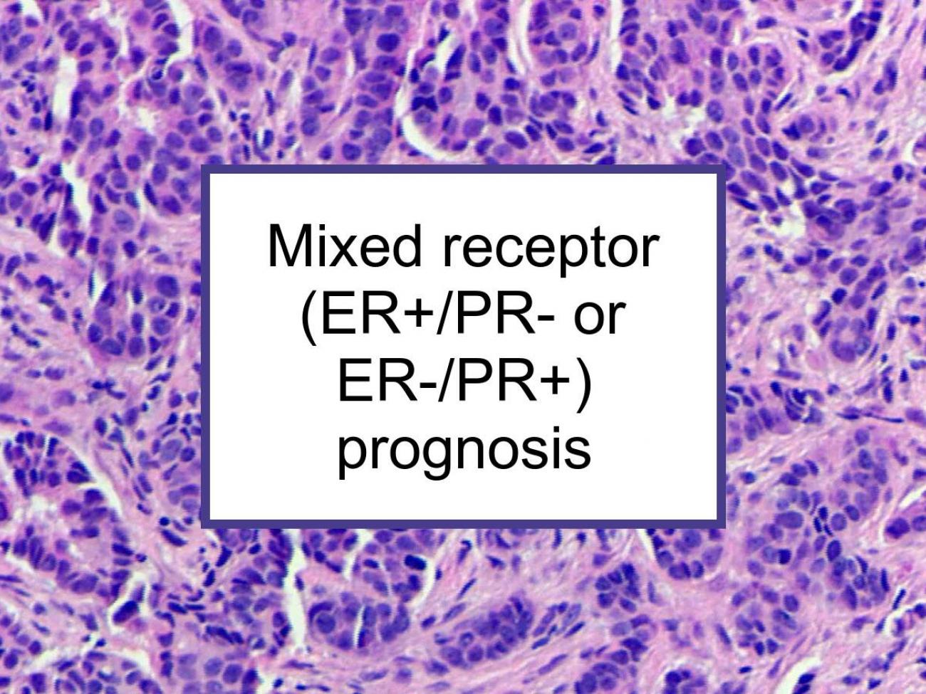 Mixed Hormone Receptor (ER+/PR- Or ER-/PR+) Breast Cancer