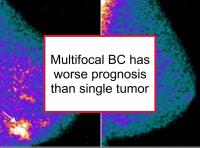 Multifocal breast cancer has worse prognosis