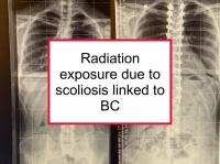 Radiation exposure due to scoliosis linked to BC