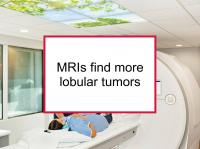 MRIs find more lobular tumors