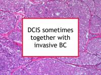 DCIS sometimes together with invasive BC